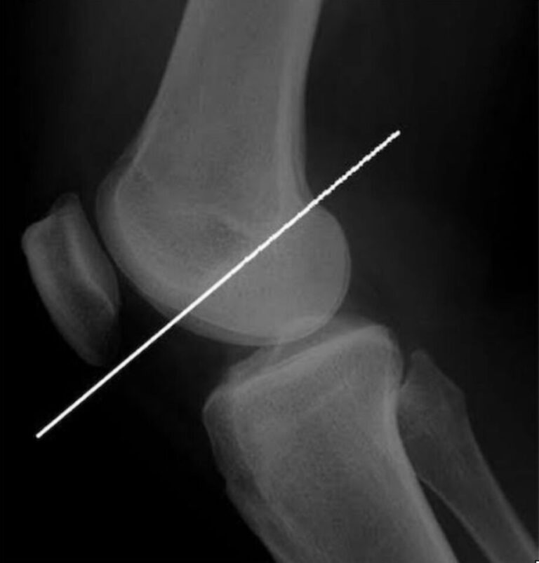 ブルメンザッツライン(blumensaat's line)って?